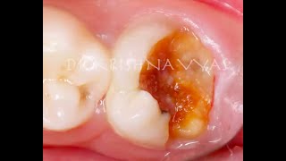 Badly mutilated teeth reinforcement with canal projection [upl. by Tenenbaum529]