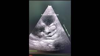 Case68 echocardiography for Kawasaki Disease with dilated RCAampLCA LCA aneurysm and thrombus [upl. by Ezzo312]