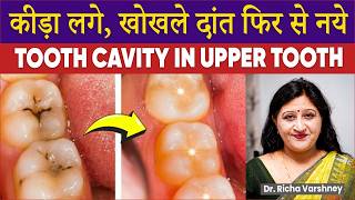 Upper Teeth Decay  Cavity Removal at Home [upl. by Llenaej458]