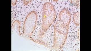 Insufficient levels of Pms2 ERCC1 Ku86 and CcOI contribute in the progression of colon cancer [upl. by Hgierb514]