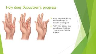 Dupuytrens Contracture Treatment  Everything You Need to Know [upl. by Germayne]