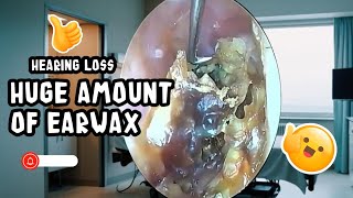 Cleaning a large amount of earwax that severely blocks the ear canal earwaxremoval earwax asmr [upl. by Ecyarg]