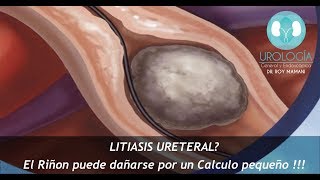 LITIASIS URETERAL  Dr Roy Mamani [upl. by Marvella]