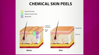 Chemical Peel Purpose amp Types [upl. by Suiravaj436]