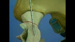 posterior screw fixation of the sacroiliac joint [upl. by Sumahs]