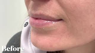 Watch This Lip Filler Transformation With Just One Syringe Of Juvéderm Volbella [upl. by Tessie]