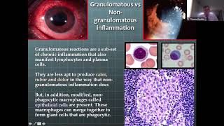 Lecture Granulomatous Disease in an Eye Practice [upl. by Grew]