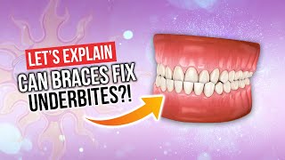 Can Braces Fix UNDERBITES [upl. by Eddina]