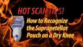 Hot Tip  How to Recognize the Suprapatellar Pouch on a Dry Knee [upl. by Haerr]