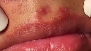 Most Painful Blackhead Removal on Lips [upl. by Laurens952]