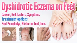 Dyshidrotic eczema on feet causes symptoms risk factors treatment options Feet pompholyx blister [upl. by Downs]