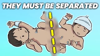 What Happens When Conjoined Twins Must Be Separated [upl. by Leirza684]