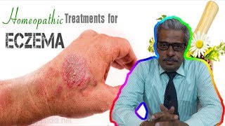 Eczema Dermatitis Treatment in Homeopathy by Dr PS Tiwari [upl. by Pricilla]