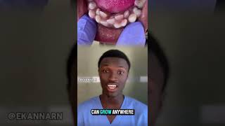 Hyperdontia is a condition where a person has extra teeth known as supernumerary teeth hyperdontia [upl. by Caz]