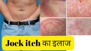 Itching over Groin area Remedies are here  Home remedies itching and infection in private part [upl. by Ennaej]