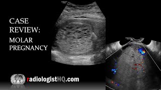 Case Review Ultrasound of Complete Molar Pregnancy [upl. by Terpstra679]