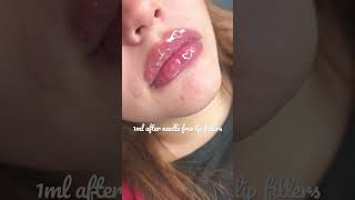 Needle free lip fillers using the Hyaluron Pen [upl. by Carline]