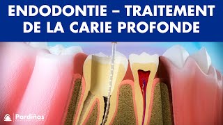 Endodontie  Traitement de la carie profonde © [upl. by Eleik]