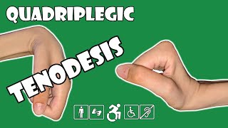 Tenodesis  Explained  Quadriplegic C5C6C7 [upl. by Kcam]