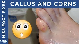 Corn and Callus non invasive removal By Miss Foot Fixer Marion Yau [upl. by Nybbor]