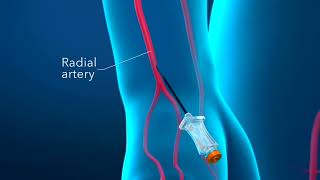 Coronary Artery AngioplastyAngioplasty ProcedureAngioplasty 3D animationStent Placement [upl. by Alfie558]