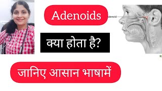 Adenoids explanation in easy language  Treatment  Homeopathy for Adenoids [upl. by Shauna]