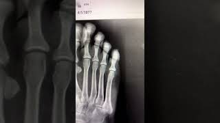 Fifth Metatarsal Fracture fracture podiatrylife footdoctor [upl. by Ronile]