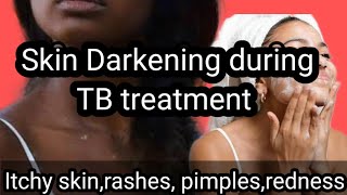 Skin Darkening during TB treatment Skin problems during TB treatment Colours of life [upl. by Yenhoj608]