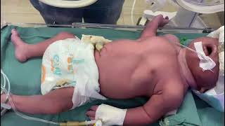 baby at NICU  subcostal retraction on CPAP drtmam [upl. by Aksehcnarf]