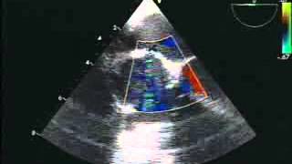 1 Acquired Left Ventricle to Right Atrial Shunt Gerbode Defect and Massive Pulmonary Embolus [upl. by Odarbil]