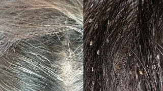 How can I tell if I have head lice or dandruff [upl. by Ahsika]