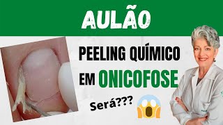 Aulão Peeling Químico em Onicofose Será que Funciona [upl. by Papagena]