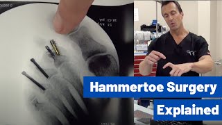 Hammertoe Correction Surgery Explained by Dr Moore  Using the Phalinx Hammertoe Fixation System [upl. by Aitnom]