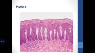 Basic Dermatopathology 9 Psoriasiform  Spongiotic [upl. by Ahsinahs490]