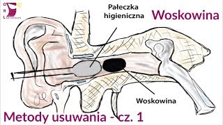 Woskowina  metody usuwania cz 1  Jak skutecznie i bezpiecznie pozbywać się woskowiny z uszu [upl. by Imotas218]