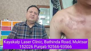 Keloid Treatment with Laser  Hypertrophic Scar  Laser Face Scar Treatment  Kayakalp Laser Clinic [upl. by Barlow]