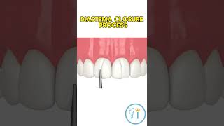 Diastema closure  How to close gap on front teeth with composite smile dentist teeth diastema [upl. by Newmark932]