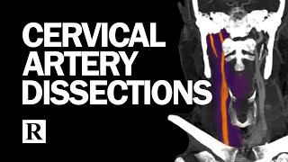 Cervical Arterial Dissections [upl. by Anavi]