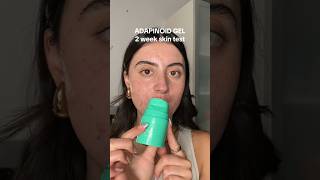 ADAPINOID GEL ON ACNE FOR 2 WEEKS skincare acnetreatment [upl. by Rebe]