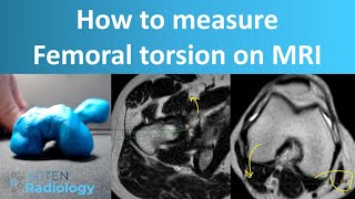 How to Measure Femoral Torsion on MRI [upl. by Bernarr198]