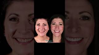 The power of neuromuscular dentistry  porcelainveneers drshawnkeller shawnkellerdds teeth [upl. by Colby]