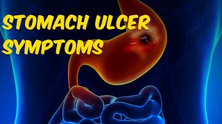 Stomach Ulcer Symptoms What Are the Warning Signs of an Ulcer [upl. by Atiruam288]