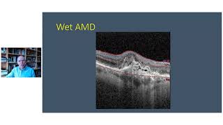 Agerelated Macular Degeneration AMD 2023 [upl. by Yrahk501]