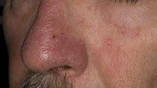 How to Treat Eczema on Face  Seborrheic Dermatitis Treatment  Face Eczema Treatment [upl. by Enirac]