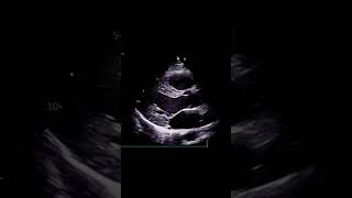 What is Attenuation echocardiography [upl. by Stefan]