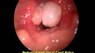 Pedunculated Vocal Cord Polyp Polyp [upl. by Naloj495]