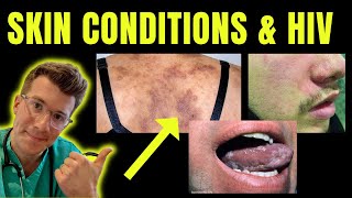 Doctor explains skin conditions associated with HIV  AIDS eg Kaposi sarcoma candida amp more [upl. by Padegs]