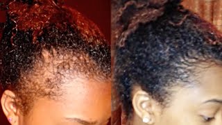 How to Regrow your Edges Bald Spots and Thinning Hair [upl. by Denney]