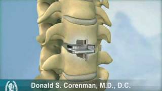 ProDiscC  Cervical Artificial Disc Replacement  ACDF Fusion  Orthopedic Spine Surgeon in Vail [upl. by Inobe]