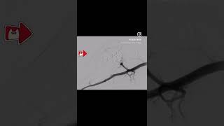 PAINFUL GROWING SWELLING ARTERIOVENOUS MALFORMATION TREATMENT BY embolization PINHOLE PROCEDURE [upl. by Shriner]